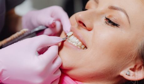 faccette dentali